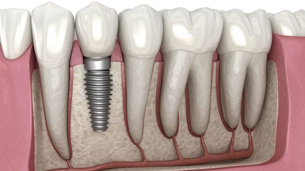 Dental Implants After 60: Is It Too Late?