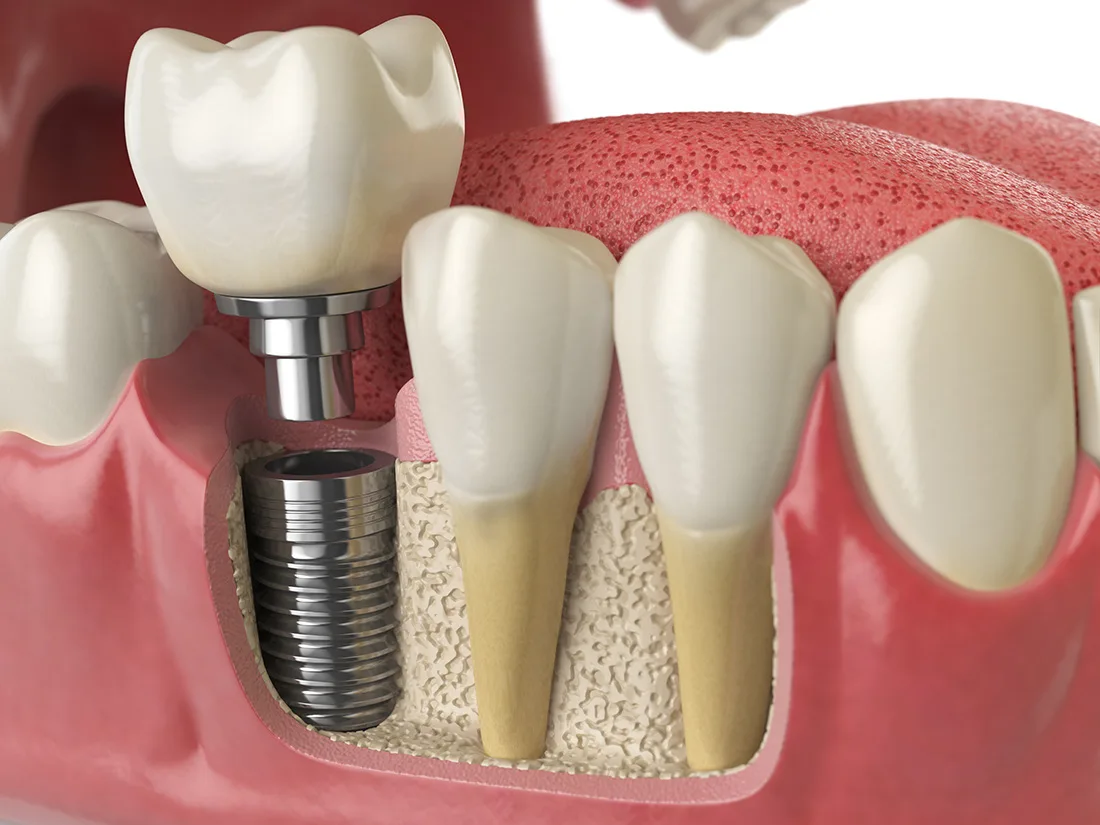 dental implants in Guiseley